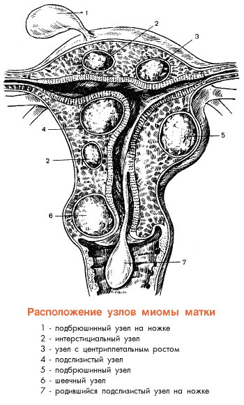 Расположение узлов миомы матки